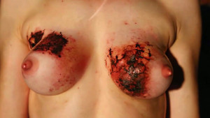 Обожжённая грудь.jpg